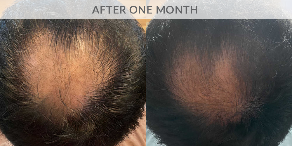 Microneedling results after one month