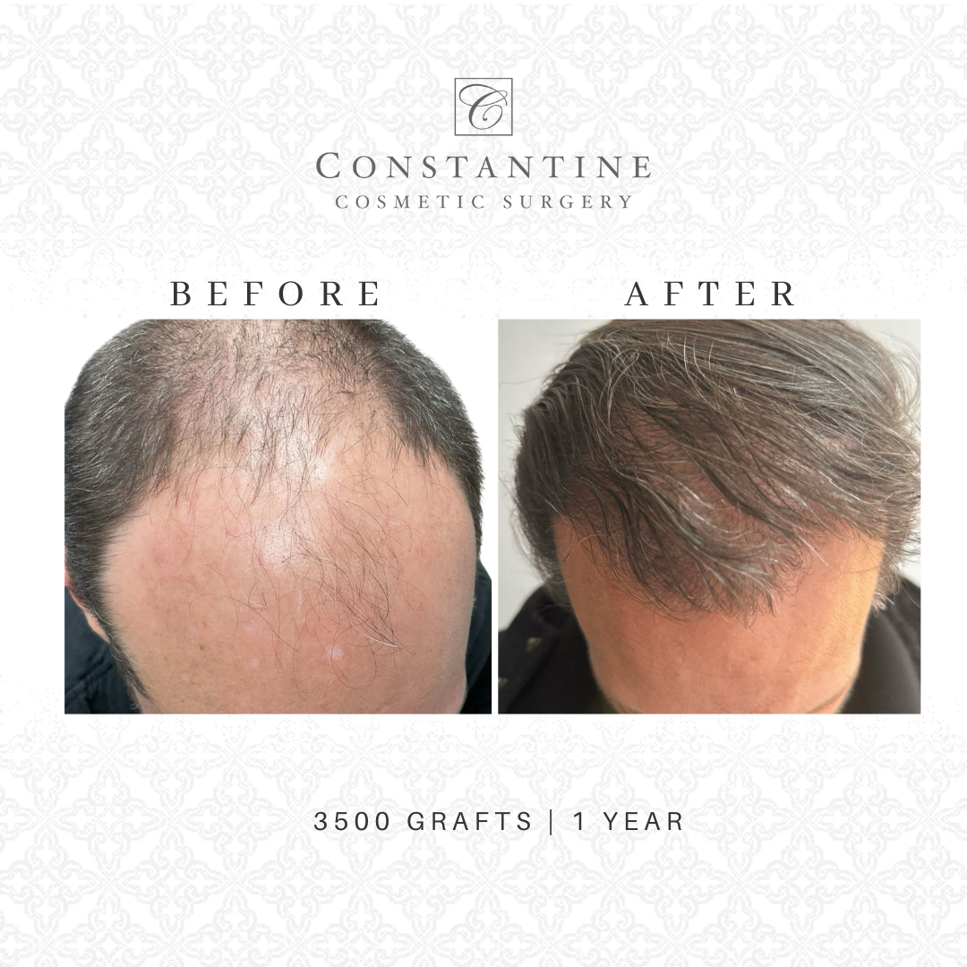 Hair Restoration Before and After - 3500 grafts | 1 year