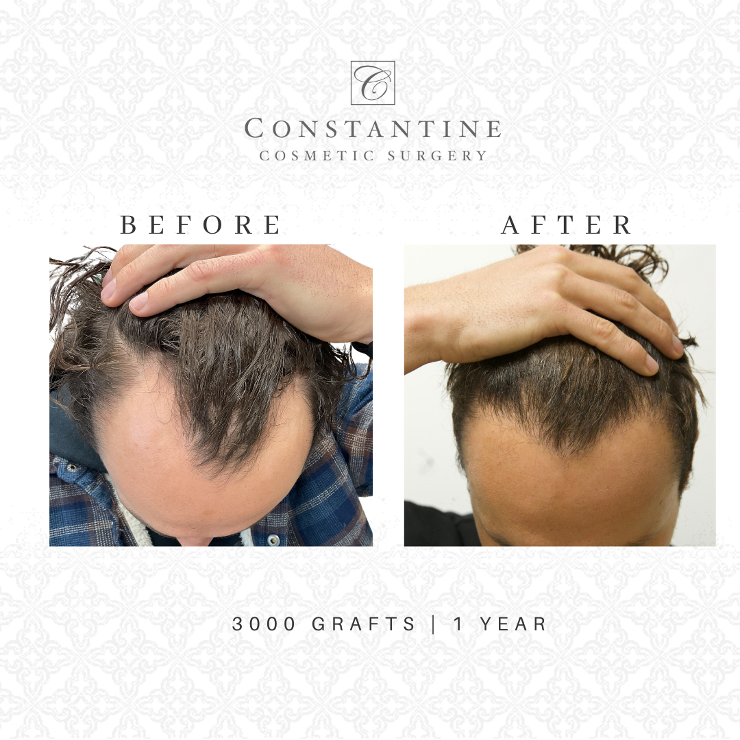 Hair Restoration Before and After - 3000 grafts | 1 year