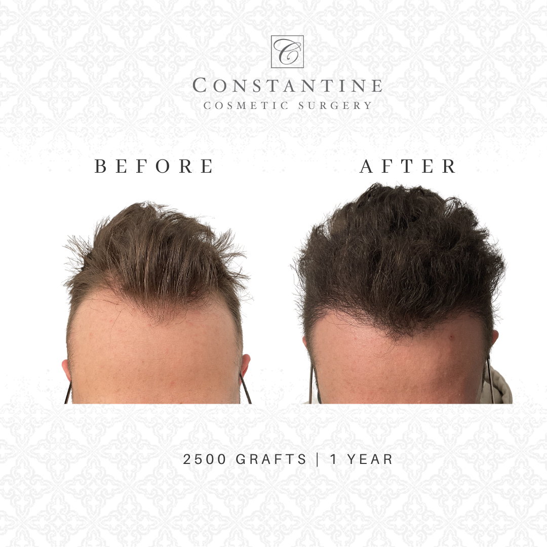 Hair Restoration Before and After - 2500 grafts | 1 year